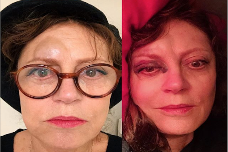 Celebrity Injuries Susan Sarandon