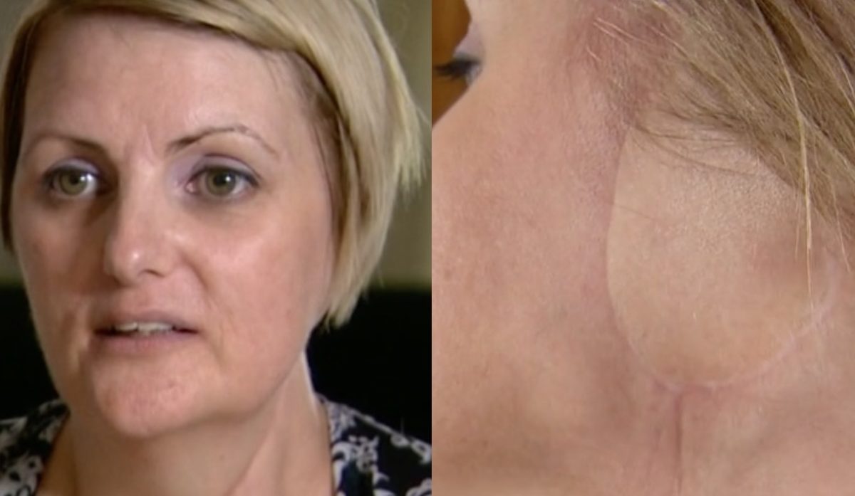 Mom Has Ear Amputated After Getting Skin Cancer Due to Tanning Addiction, Now She Wants Others to Learn From Her Mistakes