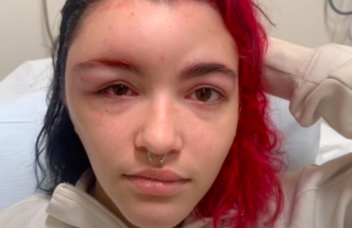 19-Year-Old Goes Viral On TikTok After Recording Her Allergic Reaction To Hair Dye