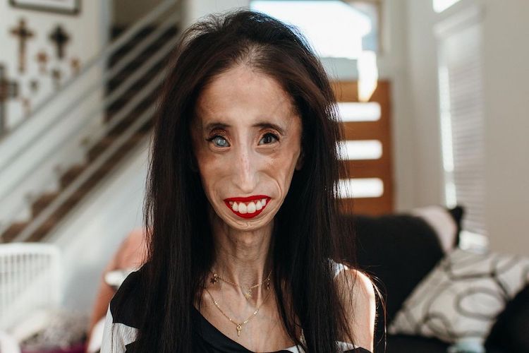 Who Is Lizzie Velasquez?