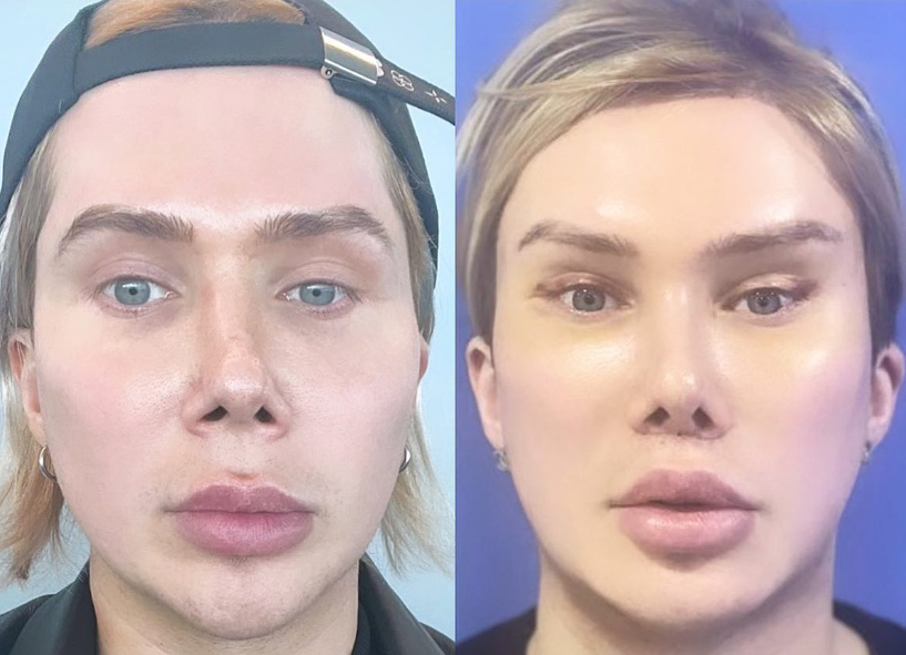 Influencer and Plastic Surgery Fanatic, Oli London, Announces His Intent to Detransition Back to Male